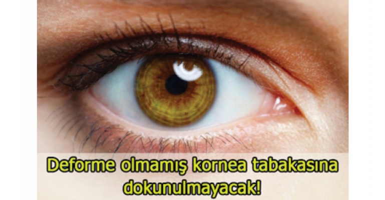 Artık sadece deforme kornea tabakası değişecek
