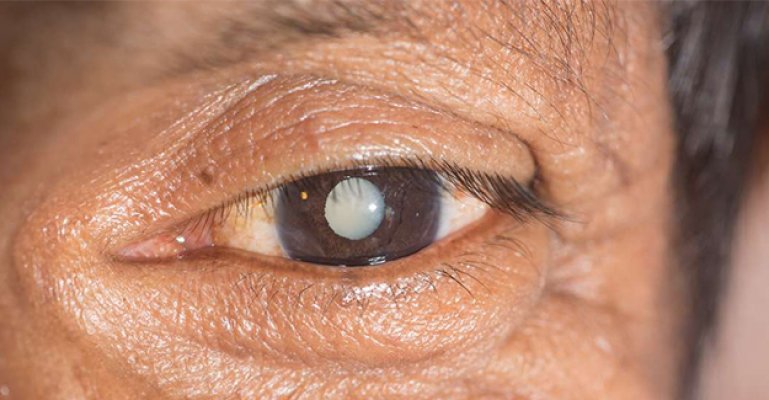 Katarakt İçin Göz Damlası Tedavisi Geliştirildi