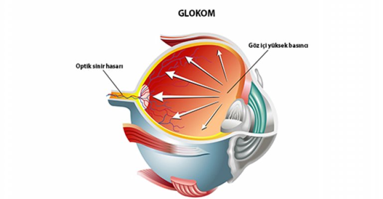 Göz Tansiyonunu Hafife Almaya Gelmez!