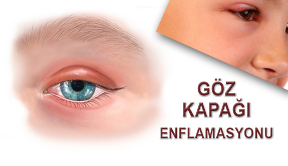 Göz Kapağı Enflamasyonu Nedir?