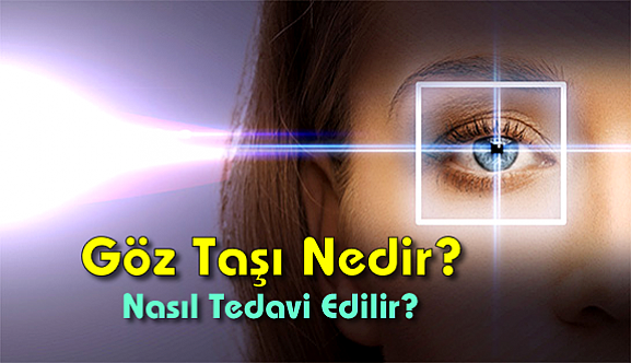 Göz Taşı Nedir? Nasıl Tedavi Edilir?