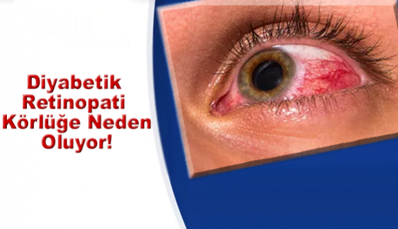 Diyabetik Retinopati körlüğe neden oluyor!