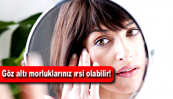 Göz altı morluklarınız ırsi olabilir!