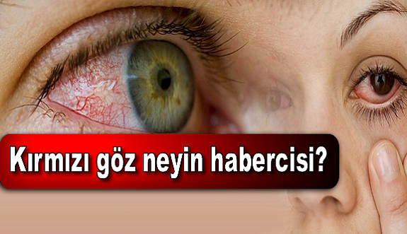 Kırmızı göz neyin habercisi?