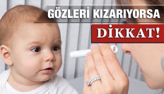 Bebeklerde Göz kızarıklığı Nedenleri