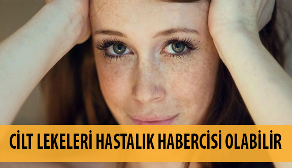 Cilt Lekeleri Hastalık Habercisi Olabilir