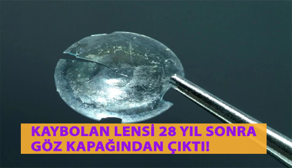 Kaybolan Lensi 28 Yıl Sonra Göz Kapağından Çıktı!