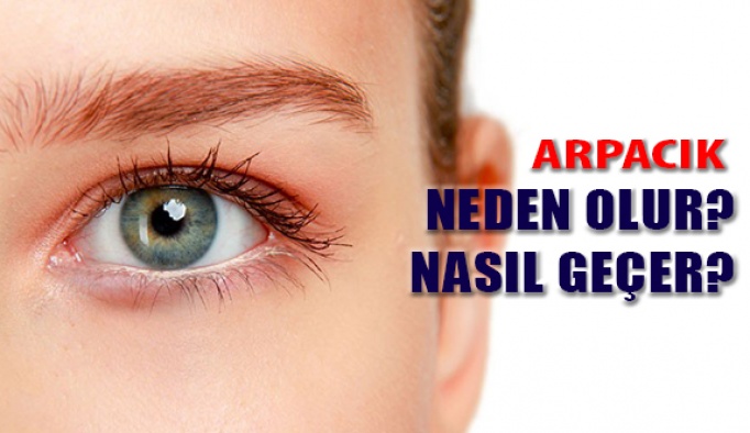 Arpacık Nedir, Neden Olur, Nasıl Geçer?