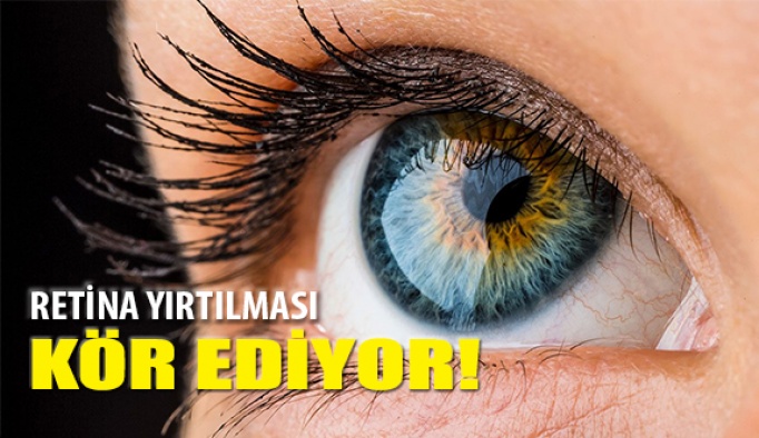 Hasarlı Retina Körlüğe Neden Oluyor