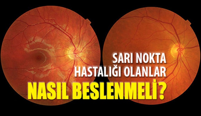 Sarı Nokta Hastalığı Olanlar Nasıl Beslenmeli?