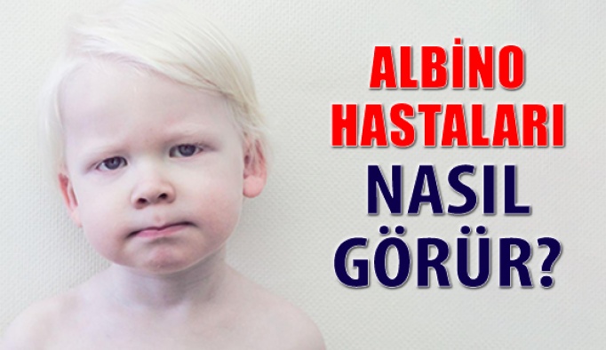 Beyaz Melek Albino Hastaları Ve Görme Kusurları