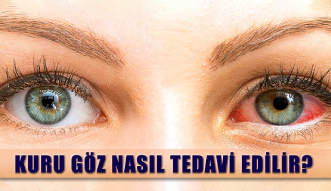 Göz Kuruluğu Nedir? Nasıl Tedavi Edilir?