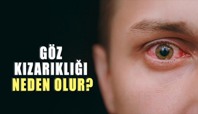 Göz Kızarıklığı Neden Olur? Nasıl Geçer?