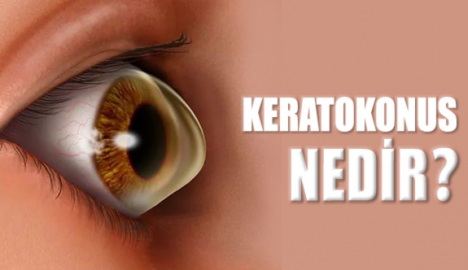 Keratokonus Nedir?