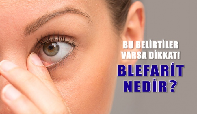 Blefarit Nedir? Nasıl Tedavi Edilir?