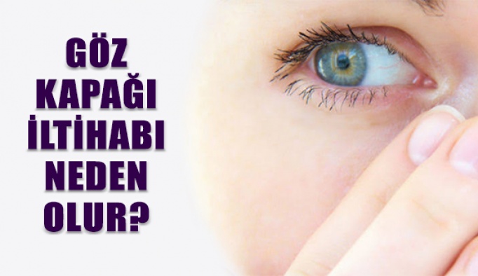 Göz Kapağı İltihabı Tedavisi Nasıl Yapılır?