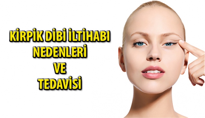 Kirpik Dibi İltihabı Nedenleri ve Tedavisi Nelerdir?