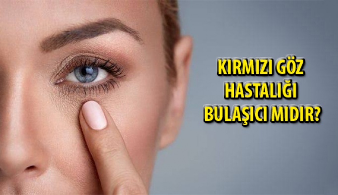 Kırmızı Göz Hastalığı nedir, Bulaşıcı mıdır?