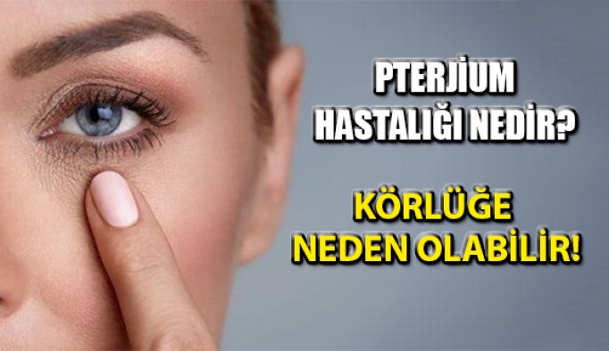 Gözün İçerisinde Ortaya Çıkan Pterjium Hastalığı Nedir?