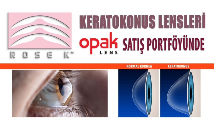 ROSE K Keratokonus Lensleri Opak Lens Satış Portföyünde