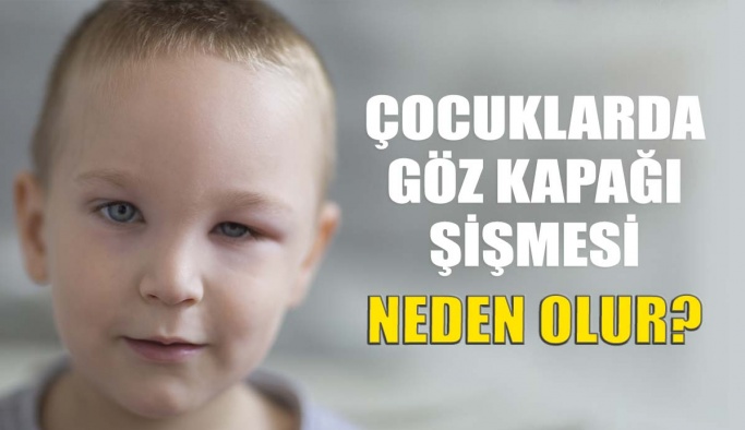 Çocuklarda Göz Kapağı Şişmesi Neden Olur?