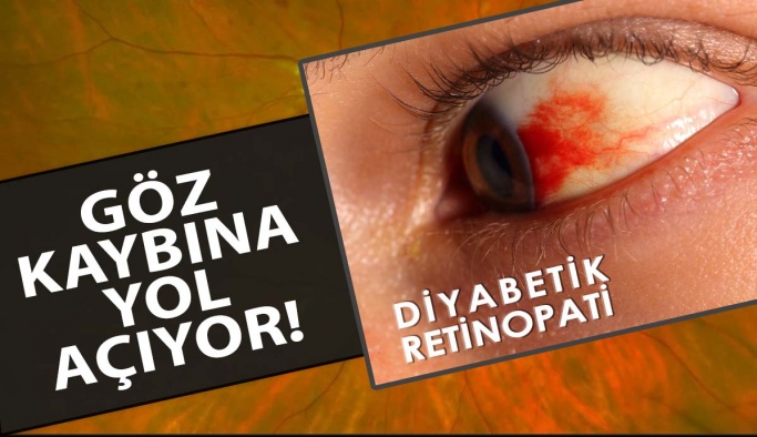 Diyabetik Retinopati Göz Kaybına Yol Açıyor!