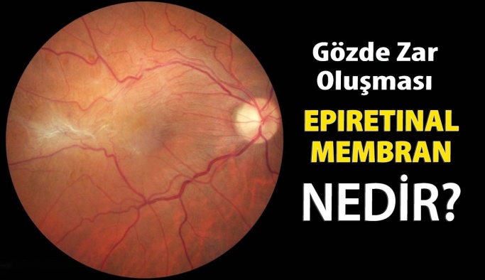 Epiretinal Membran Hastalığı Görme Kaybına Yol Açabilir!