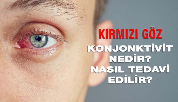 Kırmızı Göz Hastalığı Konjonktivit Nedir, Nasıl Tedavi Edilir?