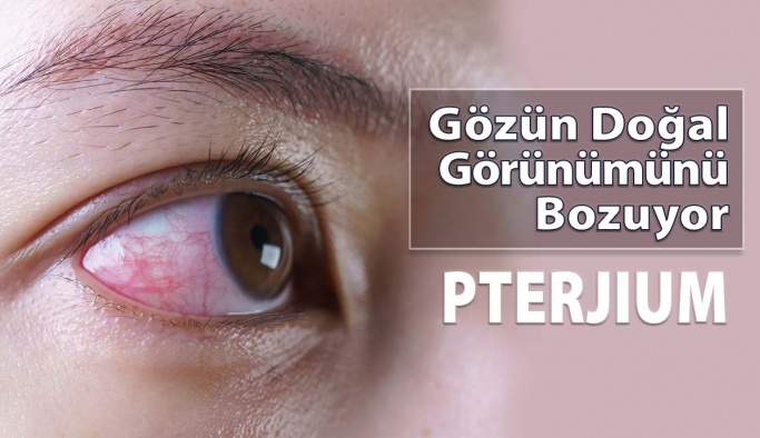 Gözün Doğal Görünümünü Bozan Hastalık: Pterjium