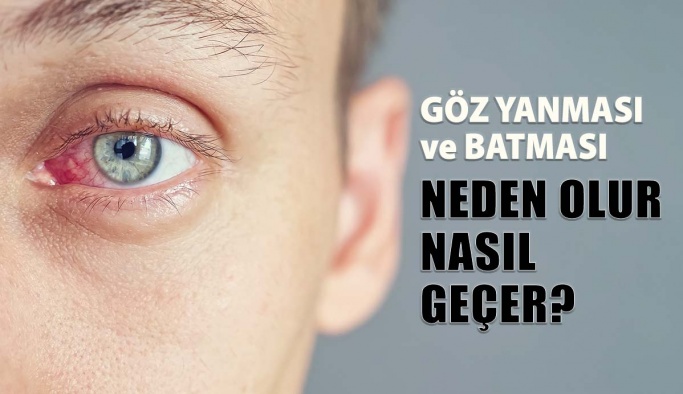 Göz Batması ve Yanması Neden Olur Nasıl Geçer?