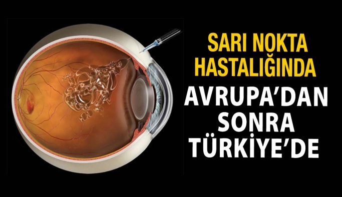 Kuru Tip Sarı Nokta Hastalığında Sevindiren Gelişme