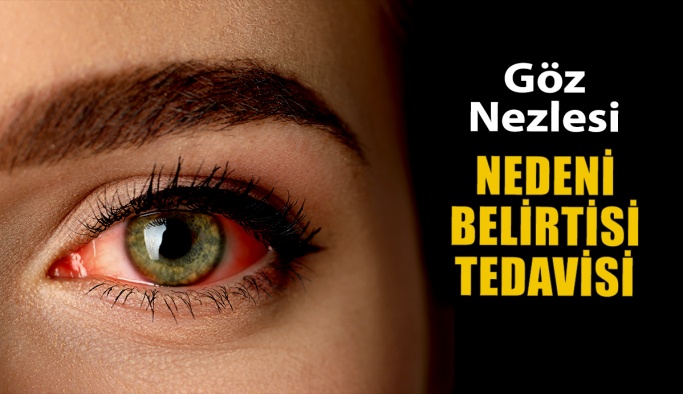 Göz Nezlesi Nedir? Nedenleri, Belirtisi ve Tedavisi