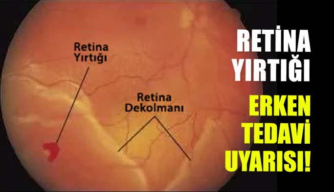 Retina Yırtığında Erken Tedavi Uyarısı