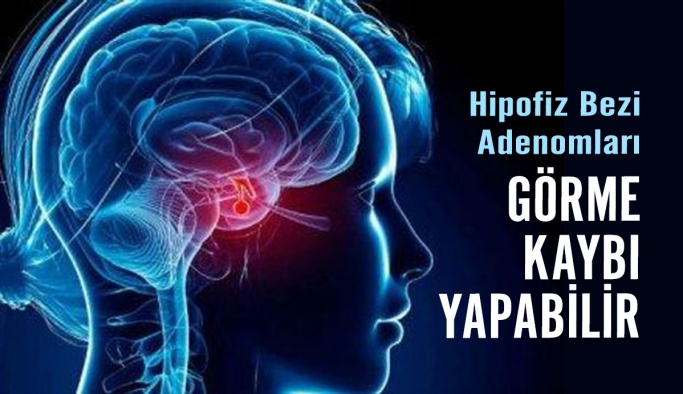 Hipofiz Bezi Adenomlari Görme Kaybi Yapabilir