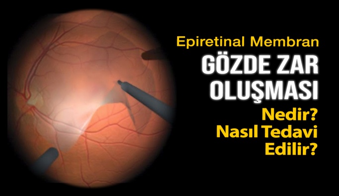 Gözde Zar Oluşması Neden Olur? Nasıl Tedavi Edilir?