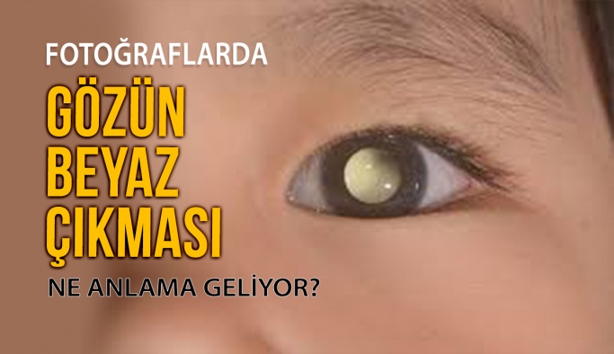 Fotoğraflarda Gözün Beyaz Çıkması Tehlikeli mi?