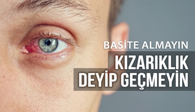 Göz Kızarıklığı Deyip Geçmeyin