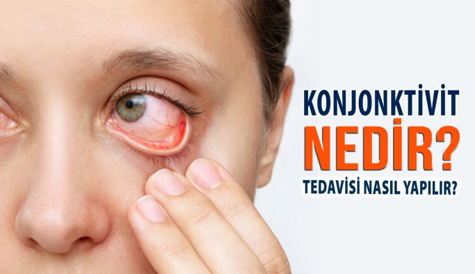 Konjonktivit Nedir? Tedavisi Nasıl Yapılır?