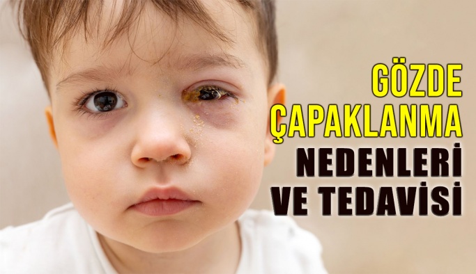 Göz Çapaklanması: Nedenleri ve tedavisi