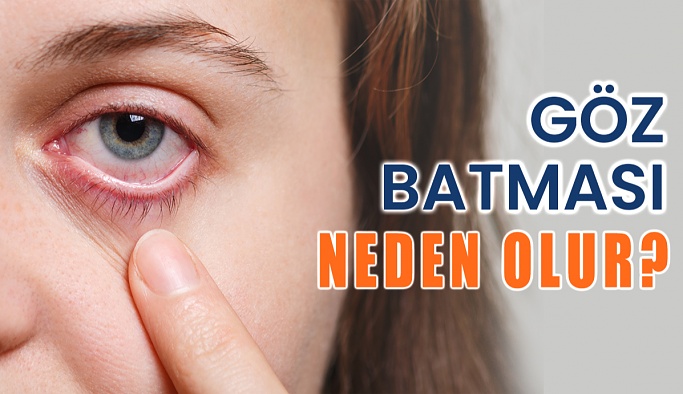 Göz Batması Neden Olur? Nasıl Geçer?