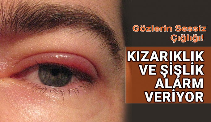 Göz Kapaklarında Kızarıklık Ve Şişlik Alarm Veriyor