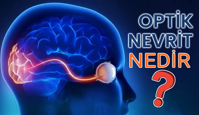 Optik Nevrit Nedir?
