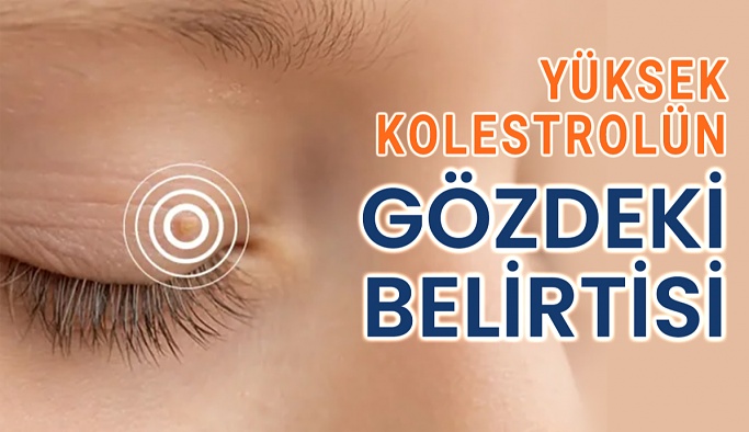 Yüksek Kolestrol Gözden Anlaşılıyor
