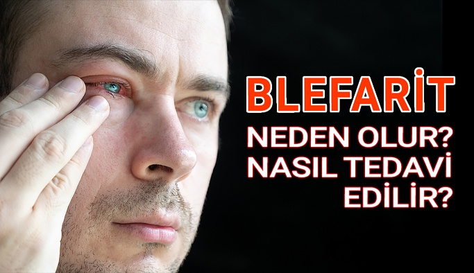 Blefarit Neden Olur Nasıl Tedavi Edilir?