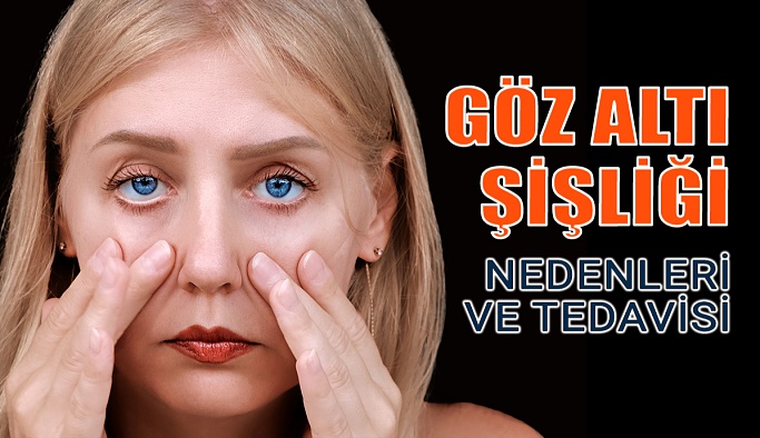 Göz Altı Şişliğine Karşı Uygulanan Tedavi Yöntemleri
