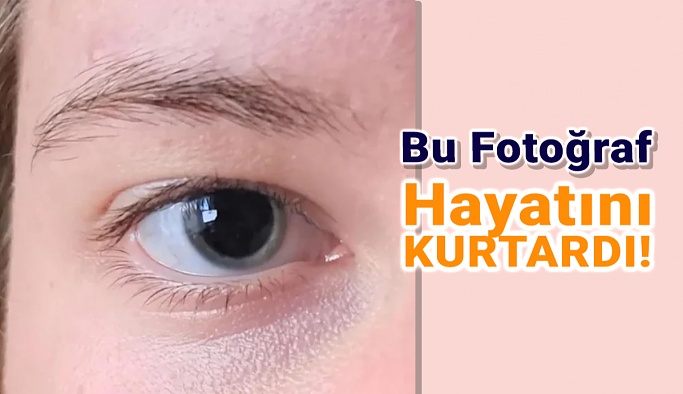 Paylaştığı Göz Fotoğrafı Hayatını Kurtardı!