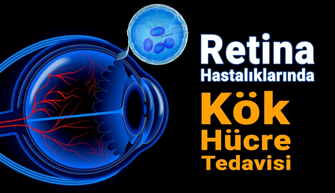 Retina Hastalıklarında Kök Hücre Tedavisi