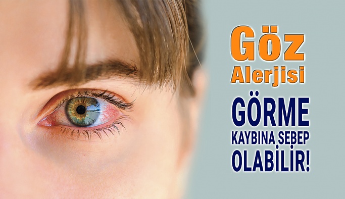Göz Alerjisi Görme Kaybına Sebep Olabilir!