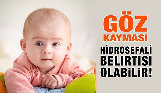 Göz Kayması Hidrosefali Belirtisi Olabilir!