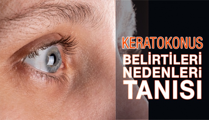 Keratokonus Nasıl Teşhis Edilir, Tedavisi Nedir?